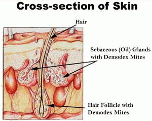 Demodex infecting eyelash hair follicle
