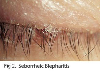 An example of Seborrheic Blepharitis